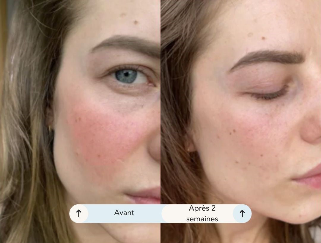 Raffinelior, masque de luminothérapie pour un soin professionnel à domicile